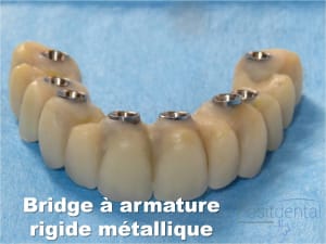 Mise en charge immédiate   implant tov  positdental 023 dhtpn2 - Eugenol