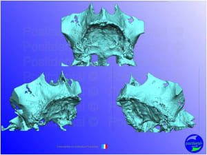 Mise en charge imm diate   expansion osseuse 008 vd5quk - Eugenol