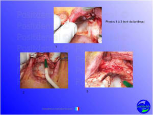 Mise en charge imm diate   expansion osseuse 012 jjtosi - Eugenol