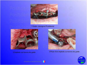 Mise en charge imm diate   expansion osseuse 013 arb803 - Eugenol