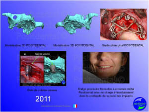 Mise en charge imm diate   expansion osseuse 015 vlk4cz - Eugenol
