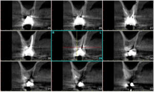 Molaire avec planmeca xnocuo - Eugenol