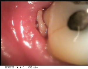 Necrose3 drwuwl - Eugenol