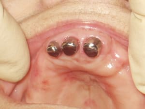 Overdenture 2 d6murc - Eugenol