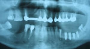 Pano imlant post op vhqz1u - Eugenol