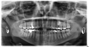 Pano m2vzxn - Eugenol