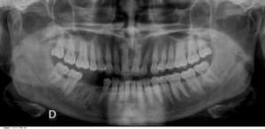 Pano occluso krxfor - Eugenol