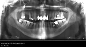 Patient 2014 ypcayw - Eugenol