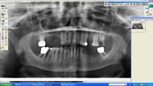 Patiente vama fiveqp - Eugenol