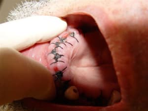 Post op hvbat7 - Eugenol