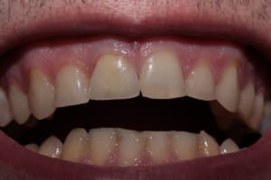 Post op j 0 iqf6tl - Eugenol
