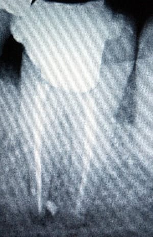 Postop36 ortuxf - Eugenol