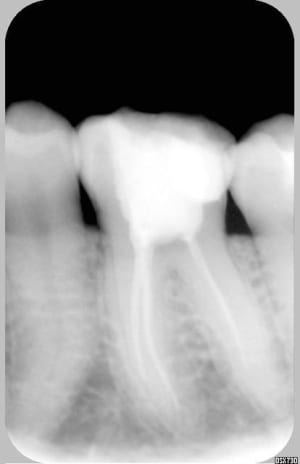 Postop prat1 yuwsn8 - Eugenol