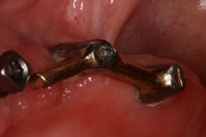 Pr op proth ses sur implants haunt bas 007 efaykv - Eugenol