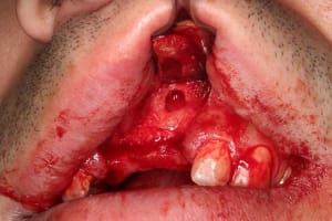 Premiere cavit  uplqpe - Eugenol