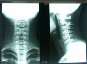 Radiocervicales stxith - Eugenol