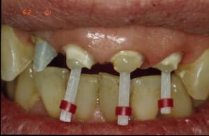 Reconstitution 1 lfbinh - Eugenol