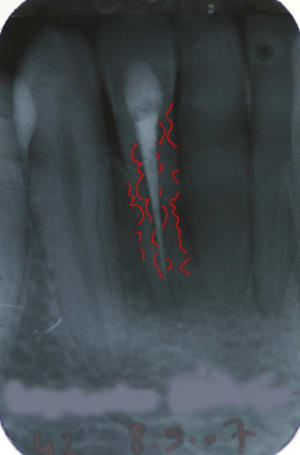 Resorption chqiaw - Eugenol