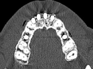 Scanner implant 12 i rucbqe - Eugenol