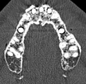 Scanner implant 12 v pbmqlg - Eugenol