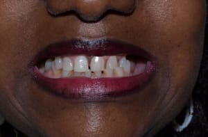 Simulation sans allonger le bord libre des dents maxillaires a63wko - Eugenol