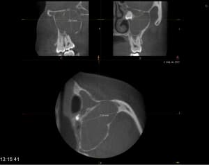 Sinuscbct j1otal - Eugenol