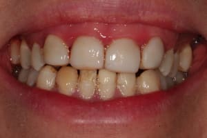 Sourir s2tfm0 - Eugenol