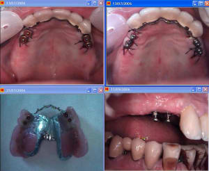 Stellite   implant kyve51 - Eugenol