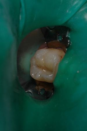Strat dentine1 h6hdmg - Eugenol