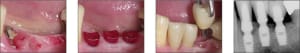 Surgical 1s hs4t3a - Eugenol