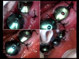 Sutures terminées edfxsa - Eugenol