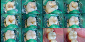 Technique directe iubvu3 - Eugenol