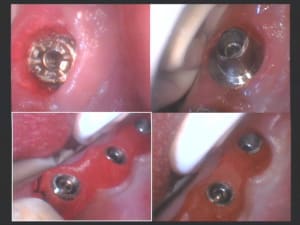 Vissage piliers sur implants 37  36 et 35 ii xa2wjq - Eugenol