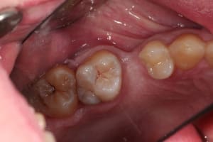 Vrai patient2 du5hmy - Eugenol