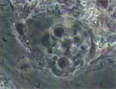 Échographie fbervl - Eugenol