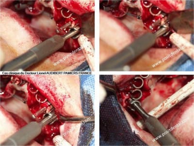005 guide chirurgical dentaire positdental uvlukc - Eugenol