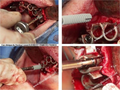 006 guide chirurgical dentaire positdental ivwrzw - Eugenol