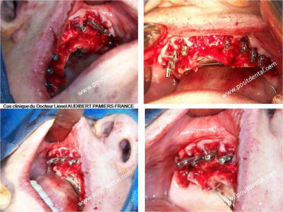 008 guide chirurgical dentaire positdental xxhajv - Eugenol