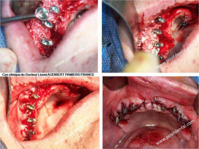 009 guide chirurgical dentaire positdental g4hpyc - Eugenol