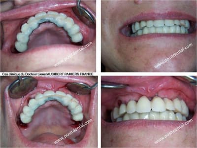 010 guide chirurgical dentaire positdental jgyujx - Eugenol