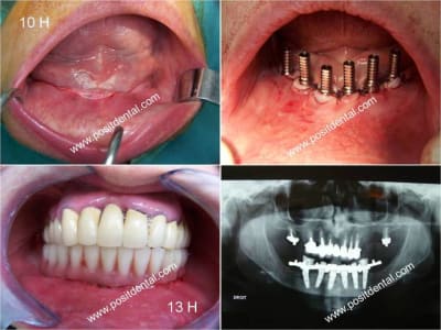 019 guide chirurgical dentaire positdental pgggxo - Eugenol
