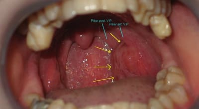 050712 dsd amygdale dcg9ez - Eugenol