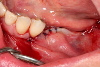 09sutures y1uug0 - Eugenol