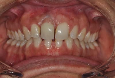 11 ecarteur xuj92r - Eugenol