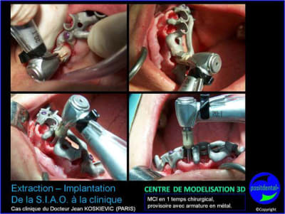 11 extraction mci bridge provisoire avec armature m tal eicf5f - Eugenol