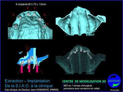 16 extraction mci bridge provisoire avec armature m tal kypdjf - Eugenol