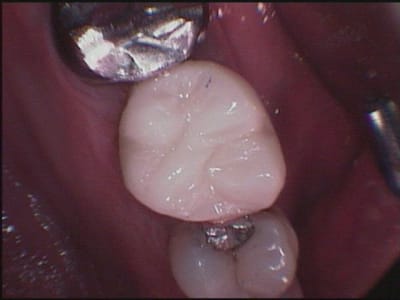 16 surélévation résine aju9ts - Eugenol