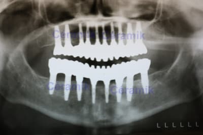 18 implants  1  tdcxcr - Eugenol