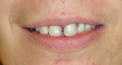 2014 sourrire stellite 3 dents ibesqm - Eugenol