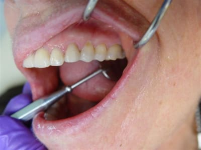 24 25 cerec et dentosophie cilk24 - Eugenol